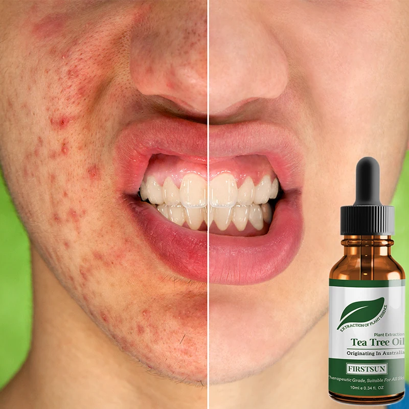 

Firstsun 100% Tea Tree Compound Essential Oil Acne Treatment Face Care Skin Oil-Control Blackhead Remover Anti Scar Spots Beauty