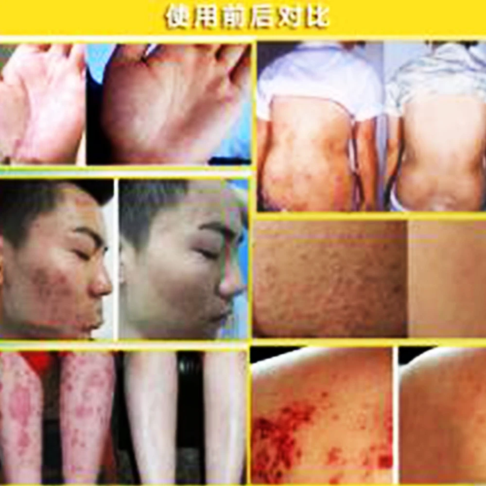 1 шт. китайская мазь псориаси экцма крем идеально подходит для все виды кожи проблемы массажный крем D084