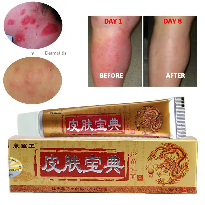 psoriasis eczema herbal cream