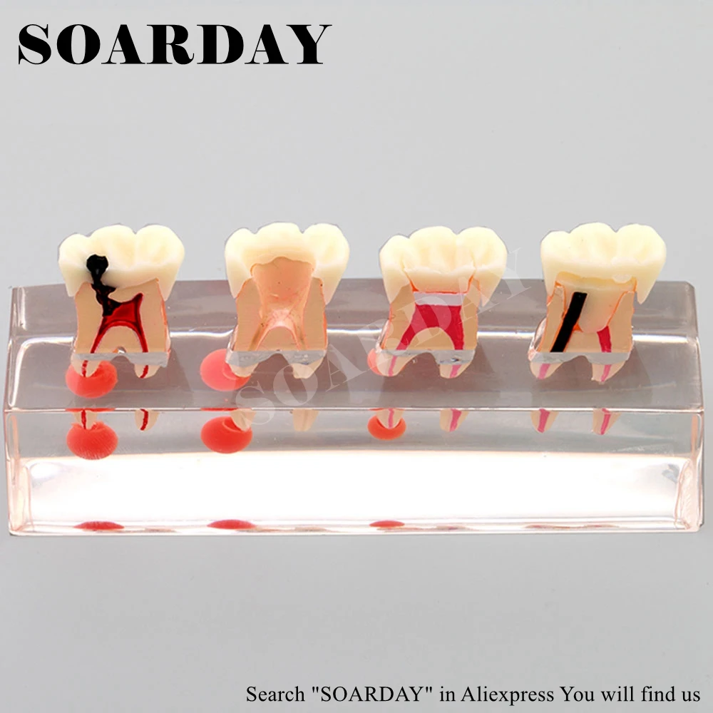SOARDAY Dental Endodontic Restoration Model Teaching Communication Model Pathological Display Dental Caries SOARDAY Dental Endodontic Restoration Model Teaching Communication Model Pathological Display Dental Caries