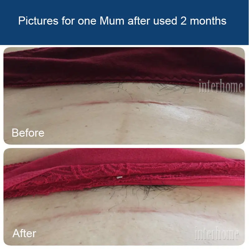 Self-adhesive-silicone-scar-paste(11)