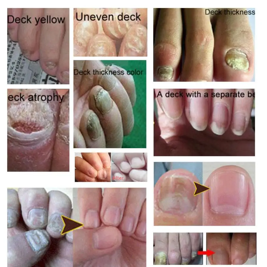 Fungal Nail Treatment Essence Nail And Foot Fungus Removal Feet Care Gel #F