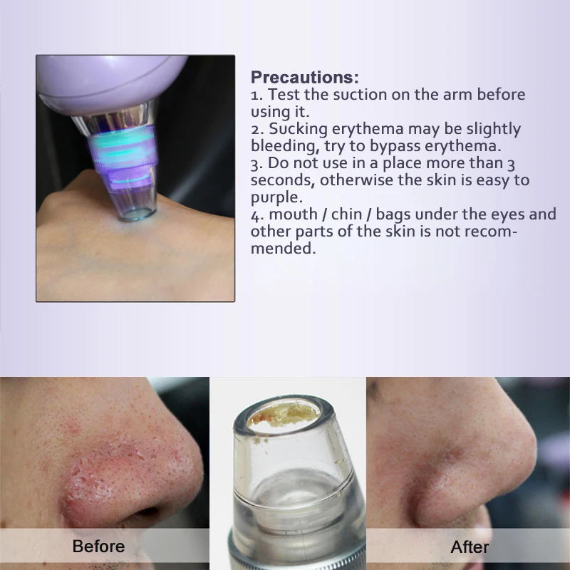 ByBaBylissnano Face Pore Cleaner Vacuum Blackhead Remover Spot Cleaner Nose Acne Comedo Suction Facial Skin Care Beauty Device