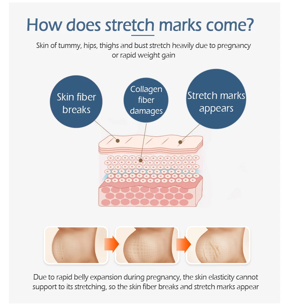 Удалить Беременность шрамы крем от акне стрейч Знаки лечение материнства ремонт антивозрастной против морщин укрепляющий Крема для тела TSLM1