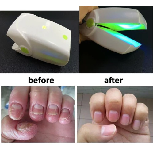 Горячая безболезненных ногтей грибок лазерное устройство с 905nm лазером для лечения грибка ногтей, лазер для onychomycosis