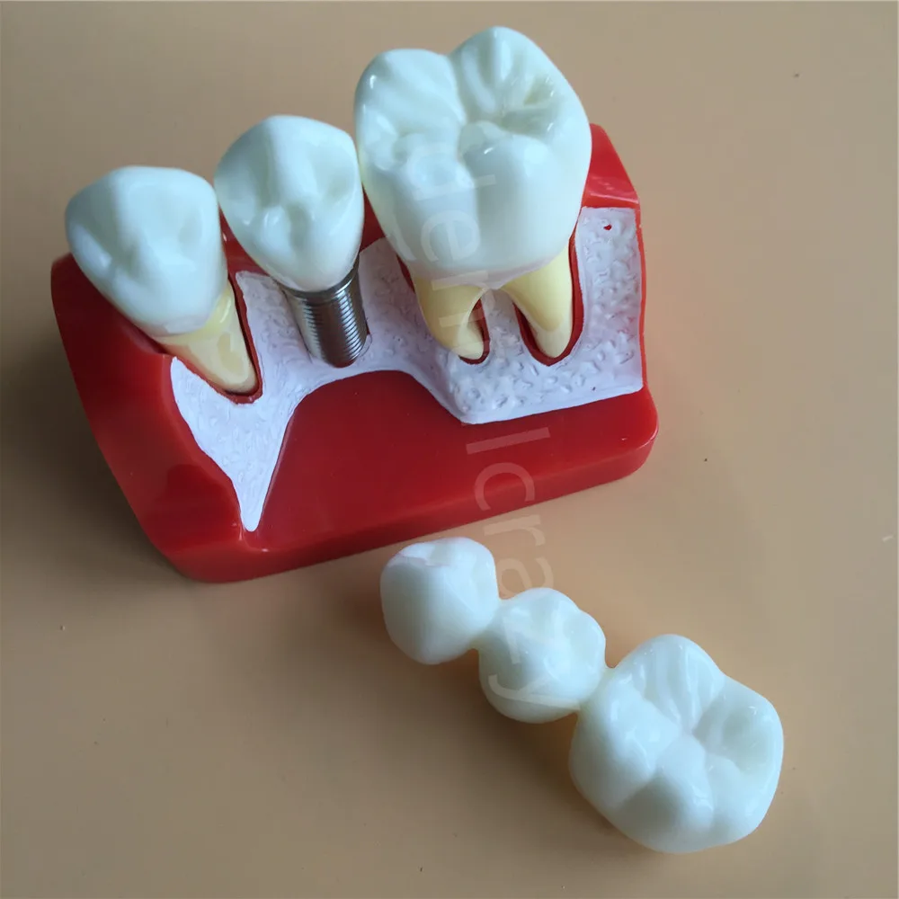 Dental Teach Implant Analysis Crown Bridge Removable Model Dental Demonstration Teeth Model