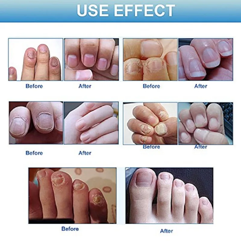 Toe Nail Fungus Treatment Of Chinese Medicine Herbs Anti Fungal Infection Essence Nail Treatment Removal Nail Care Lotion