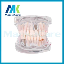 Manka Care – Removable Dental Implant Disease Teeth Model with Restoration Bridge Tooth Dentist for Medical Science Teaching