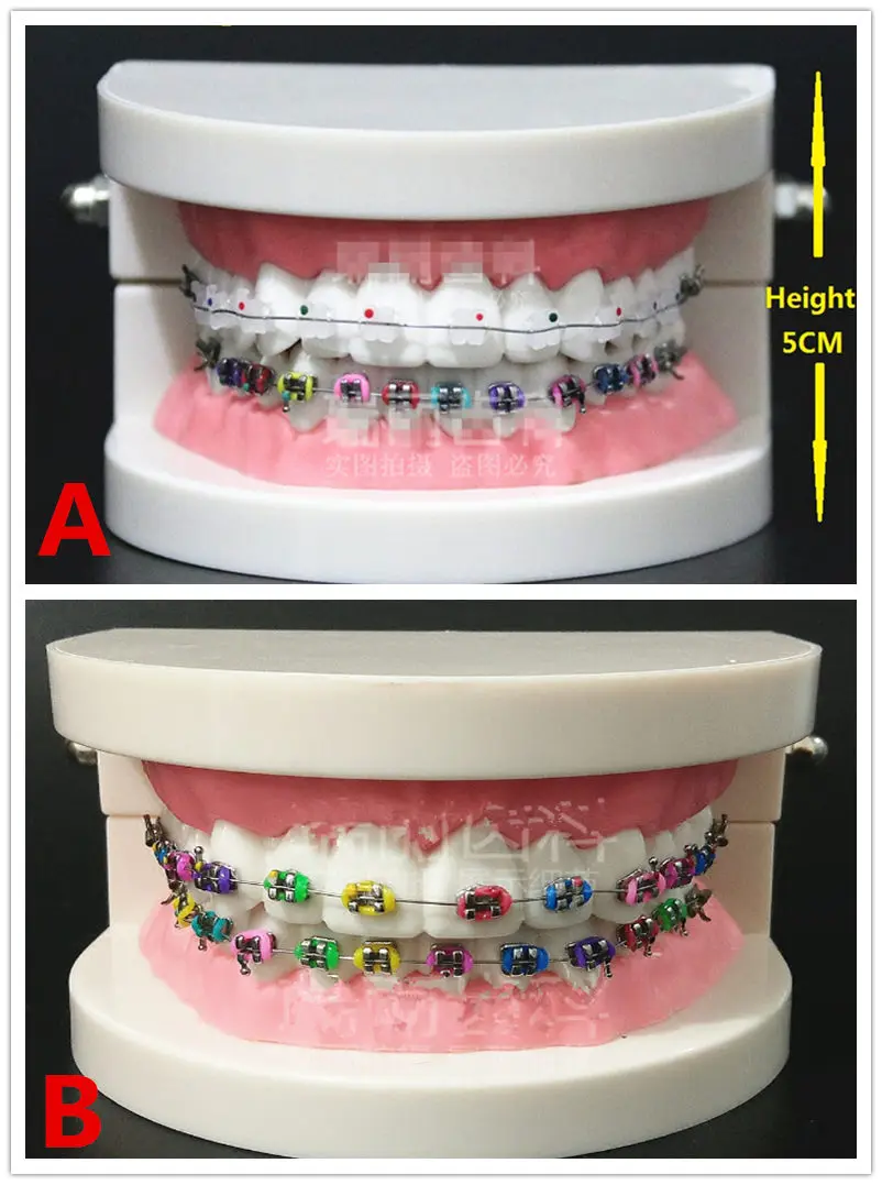 

1PC Dental Orthodontic Treatment Model With Ortho Metal Bracket Arch Wire Buccal Tube Ligature Ties