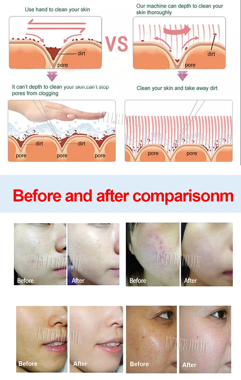 facial cleaning machine (8)