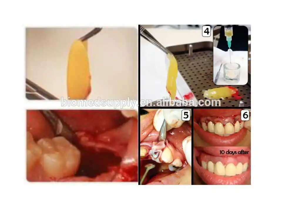 prf tube