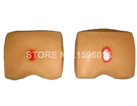 H90D  bedsore (2)