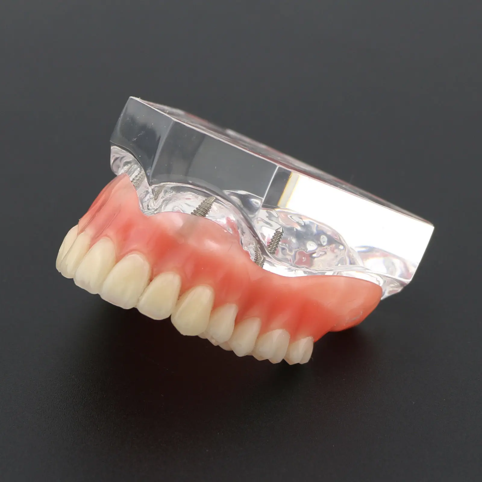 Стоматологическая модель верхних зубов Overdenture Superior 4 имплантата 6001