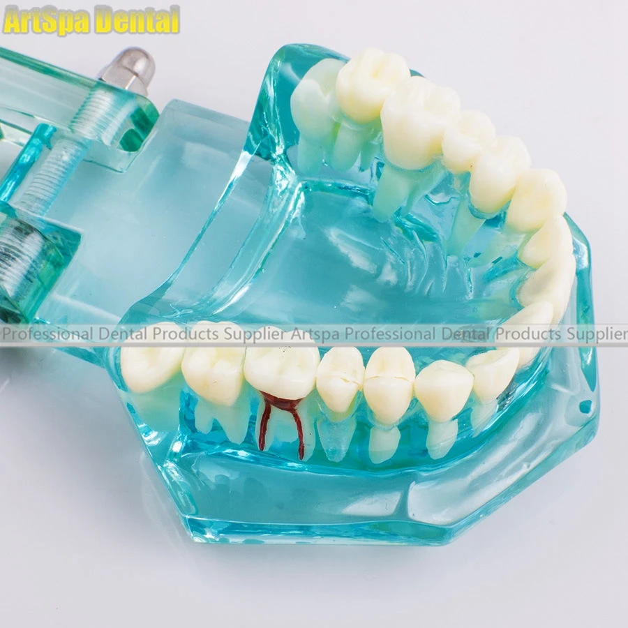  Dental Study Tooth Model Adult Pathological teaching Teeth model - 32832544472