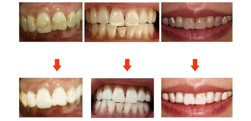 Clareamento стоматологические зубные диенты белые зубы денты Brancos Dente отбеливающая улыбка Clareador Blancos Blanqueador De Tanden Bleken