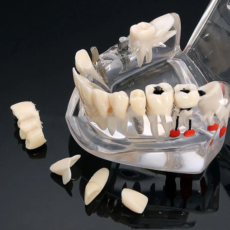 Dental Implant Disease Teeth Model with Restoration Bridge Tooth Dentist for Medical Science Dental Disease Teaching Study