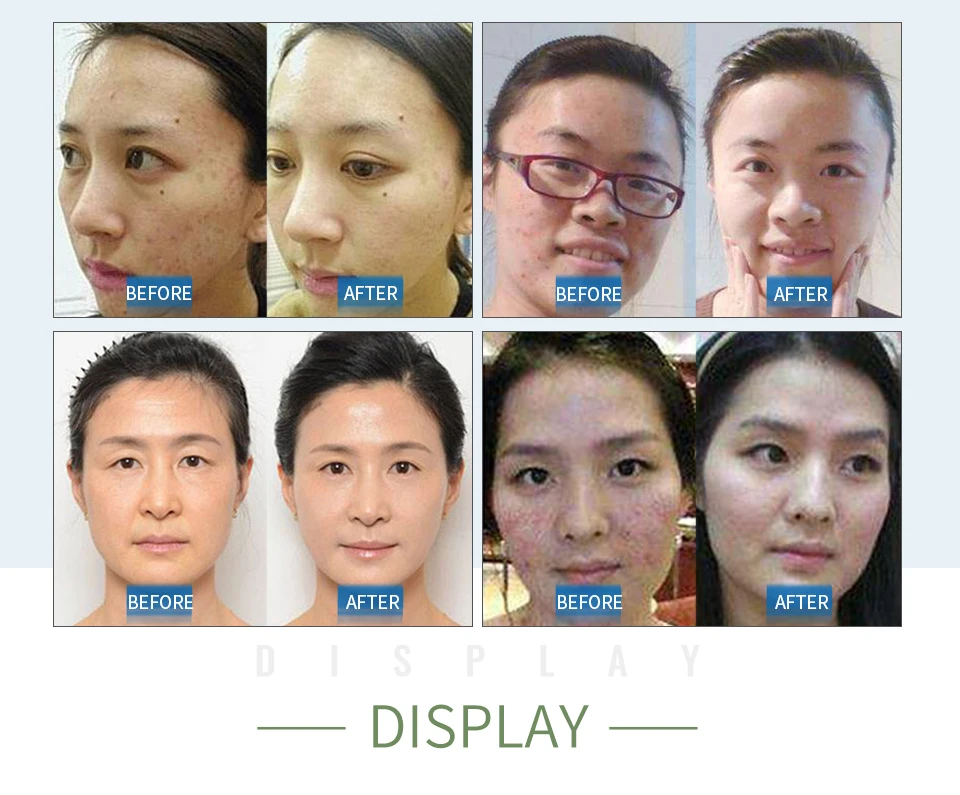 HEMEIEL анти-акне маска для лица Уход за кожей сужает поры маска для лица Ткань очищение кожи от угрей лист маска корейская косметика