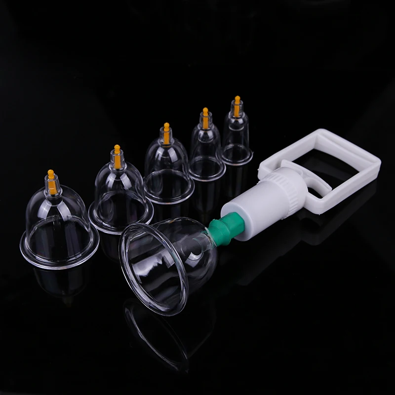 cupping (1)