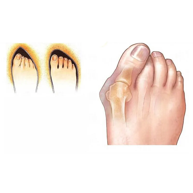 1 пара отверстие для ухода за ногами Гель-выпрямитель для ног приспособление для устранения деформации пальца на ноге корректор для снятия боли