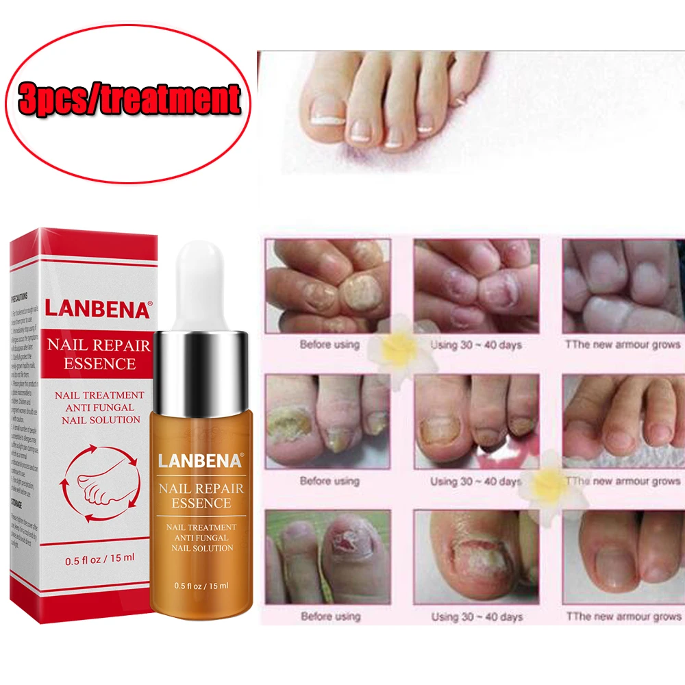 New 15ml Fungal Nail Treatment Essence Oil Feet Care Nail Polish Tools Nail Gel Armor Essence