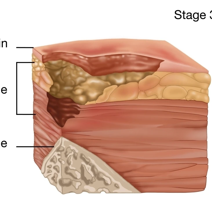 Stage 3 of a Bedsore  Illustration Poster Print by Gwen ShockeyScience Source (36 x 24)