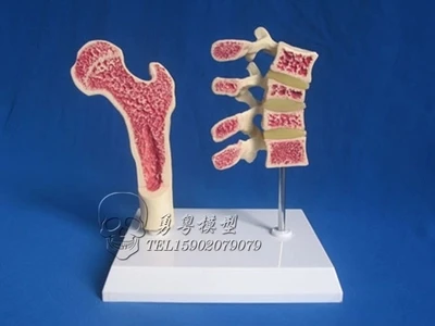 

human osteoporosis health and pathological Comparison model
