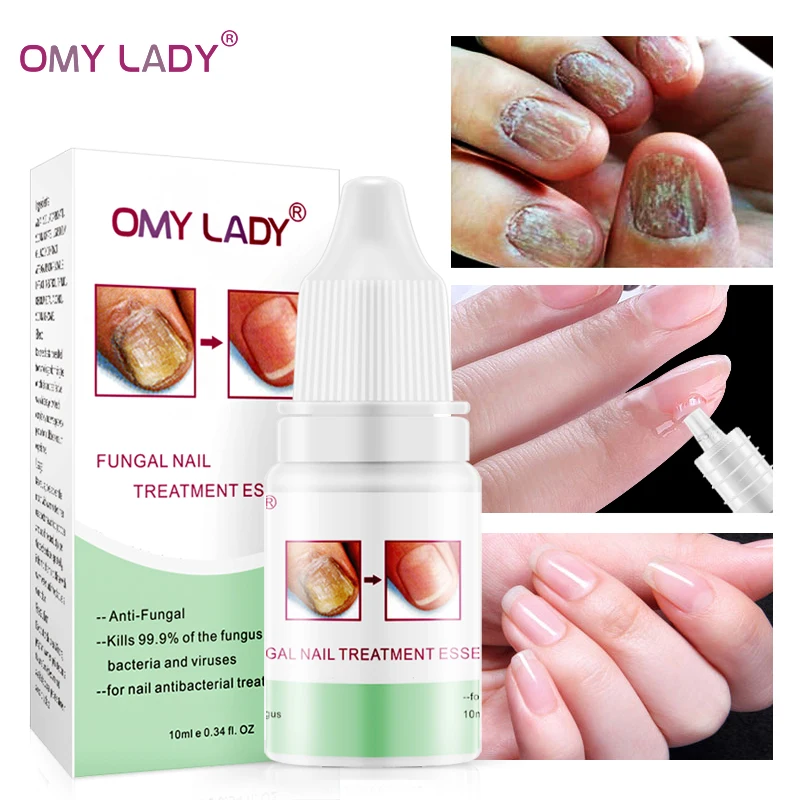 

OMYLADY Fungal Nail Treatment Essence Toe Anti Nail Fungus Infection Treatment Repair Cream Remove Onychomycosis Nail Care Tool