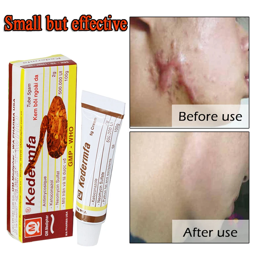 

Vietnam Remove Scar Cream Remove Acne Spots Remove Striae Gravidarum Pigmentation Corrector Anti-Aging Moisturizing 5ml