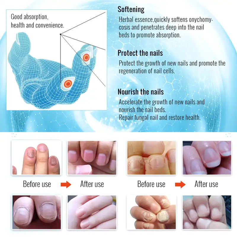 Nail Bed Infection Treatment omy lady fungal nail treatment essence nail foot whitening toe nail fungus removal gel anti infection