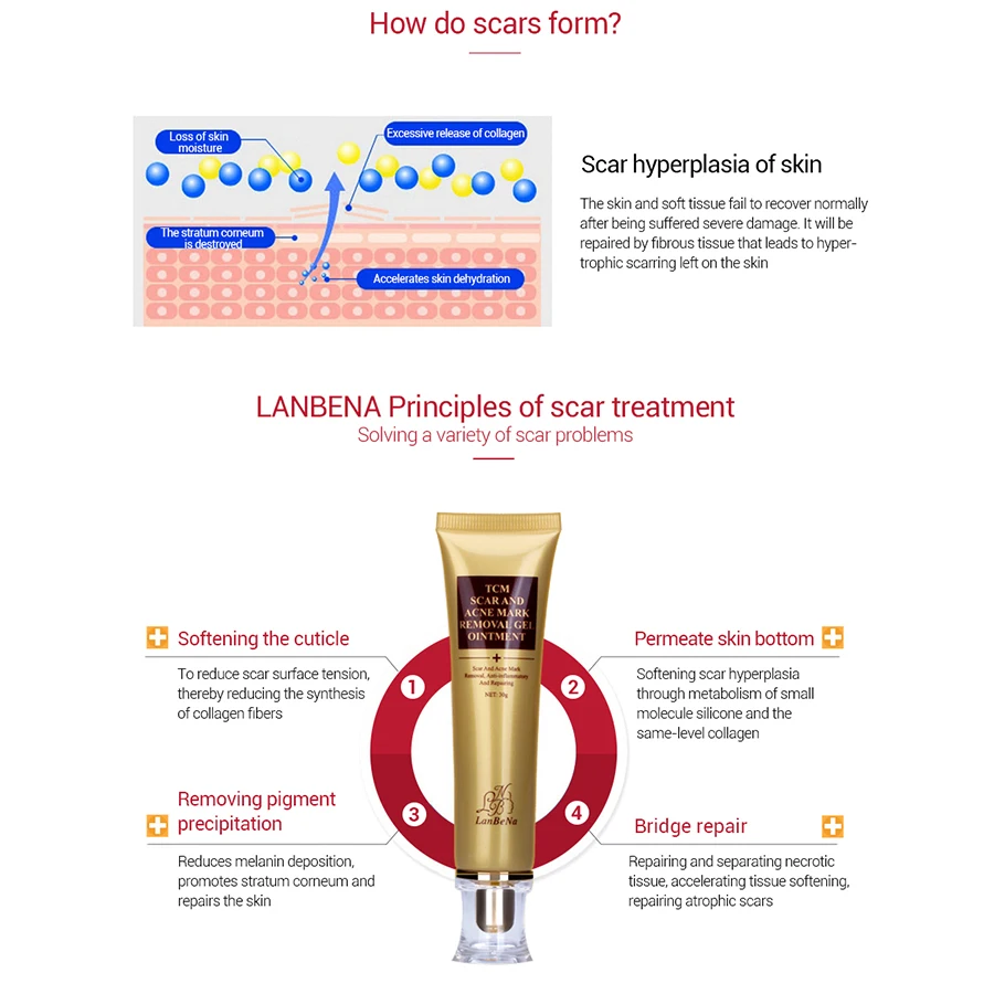 LANBENA крем для удаления шрамов от акне, крем для восстановления кожи, крем для лица от акне и пятен, лечение акне, отбеливающий крем от черных точек, растяжек, 30 мл