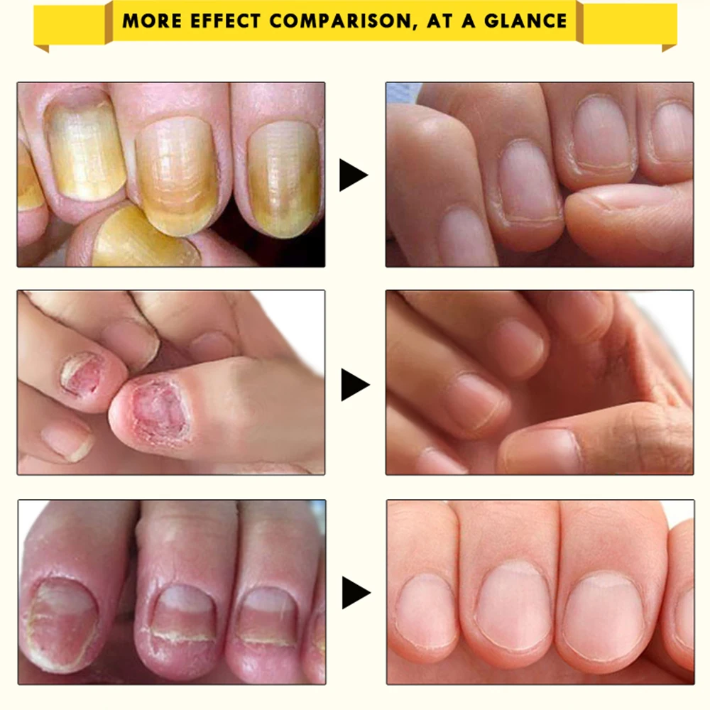 OEDO травяные антибактериальные средства для лечения ногтей эфирное масло травяной экстракт грибок для ногтей Инструменты для ремонта Уход за ногтями на ногах