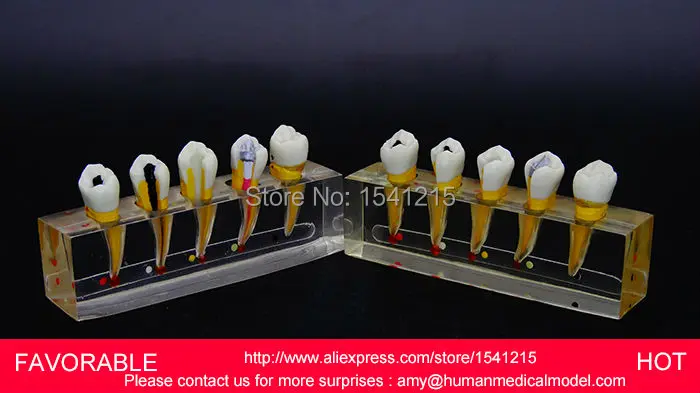DENTAL PATHOLOGY MODEL ANATOMICAL MODEL TEETH MODEL DENTAL CARIES FOR DENTAL TEETH,ENDODONTICS DENTAL MODEL DEMO 2-GASEN-DEN048 DENTAL PATHOLOGY MODEL ANATOMICAL MODEL TEETH MODEL DENTAL CARIES FOR DENTAL TEETH,ENDODONTICS DENTAL MODEL DEMO 2-GASEN-DEN048