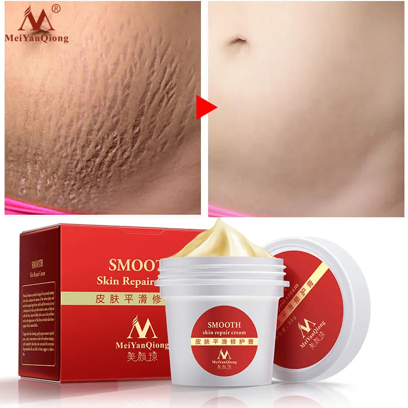 

Meiyanqiong Smooth Skin Cream For Stretch Marks Scar Removal To Maternity Skin Repair Body Cream Remove Scar Care Postpartum