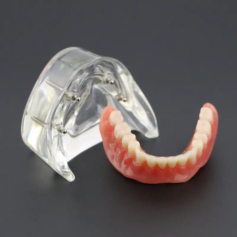 Dental Overdenture Inferior with 4 Implants Demo Model #6003 Study Teeth Model цена Dental Overdenture Inferior with 4 Implants Demo Model #6003 Study Teeth Model цены онлайн