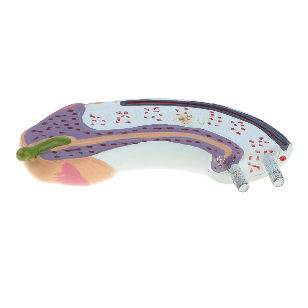 1:1 Human Male Reproduction Urinary System Pathlology Model Gonorrhea Ureteral Calculus Display Medical Study Lab Supplies