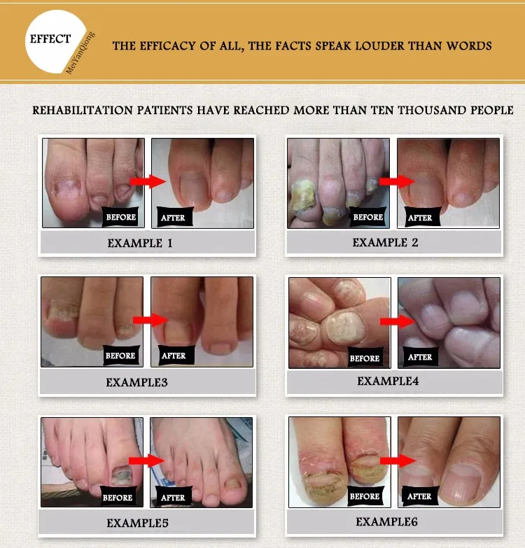 3 шт./лот грибка ногтей Уход восстановление сущность ногтей рук и ног Уход за кожей рук отбеливание ногтей против Традиционная китайская медицина, средство для удаления грибка инфекции Гель-лак для ногтей