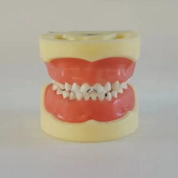 

Child Dental Caries Model