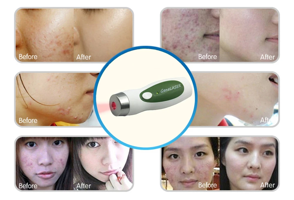 laser light skin care