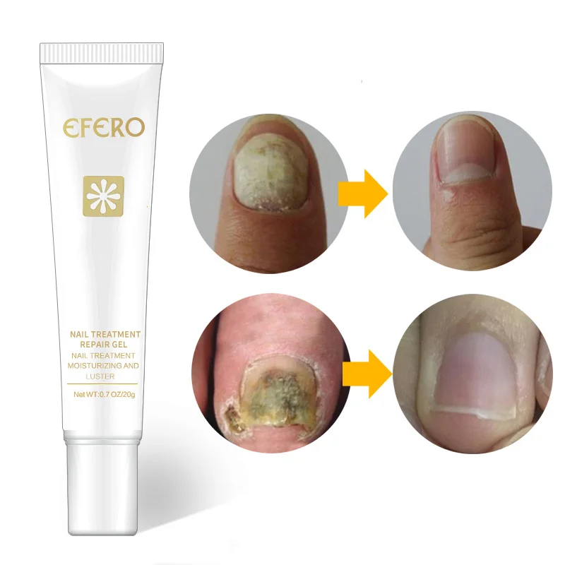 Efero Nail Fungus Treatment Onychomycosis Paronychia Anti Fungal Nail Infection Herb Good Result Toe Nail Treatment TSLM2