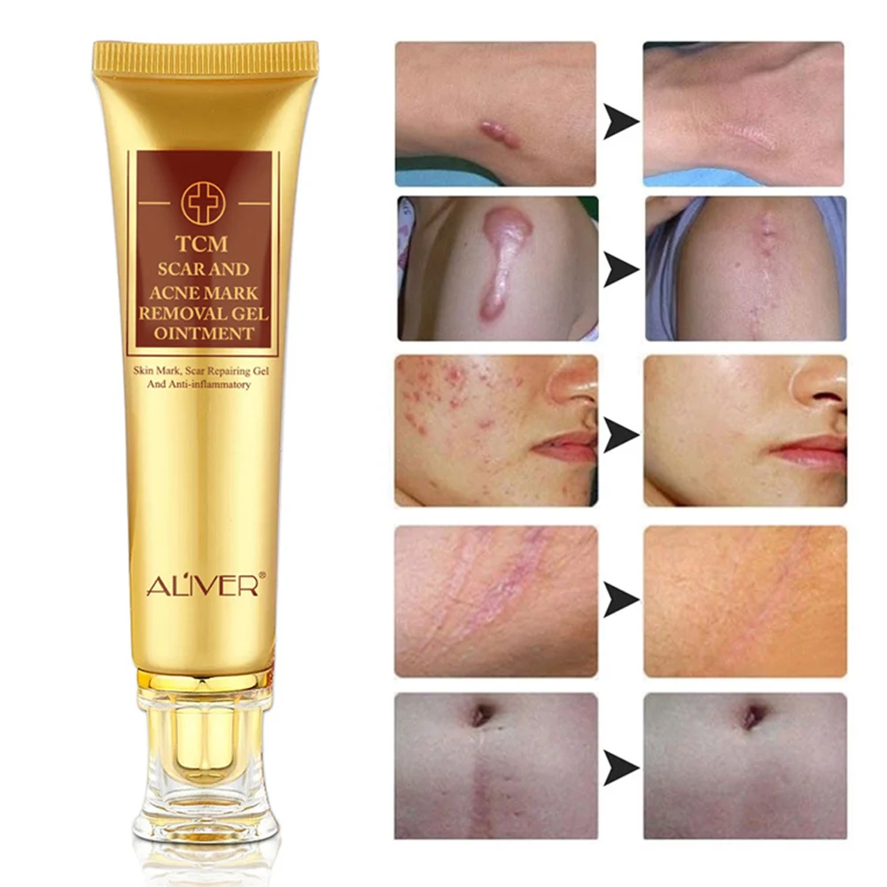 30g Acne Scar Removal Face Gel Stretch Cut Burn Spots Marks 30g Acne Scar Removal Face Gel Stretch