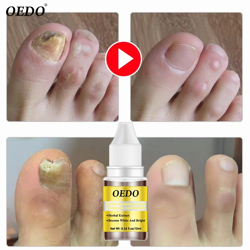 Buy Herbal antifungal nail treatment of essential oils