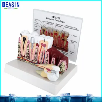 

High Quality Caries Tooth Model Dentist Patient Communication Anatomy Model Dentistry Rich Details Teaching Aids Equipment