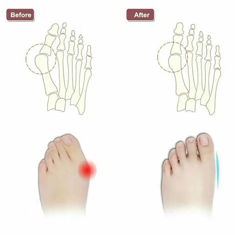 2 шт разделители пальцев ног, Силиконовый Эластичный корректор, Выпрямители для ног, разделители для пальцев, сброс для буйона, Hallux стопа с вальгусной деформацией