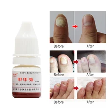 1 шт. Лечение ногтей onychomicosis Paronychia против грибковой инфекции ногтей хороший результат Китайский Травяной Уход за ногтями