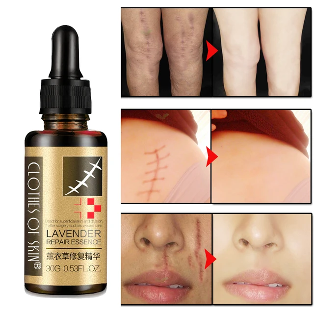 Lavender Remove Scar mark Essence Acne Scar Stretch Marks Hyaluronic acid Skin Repair Product