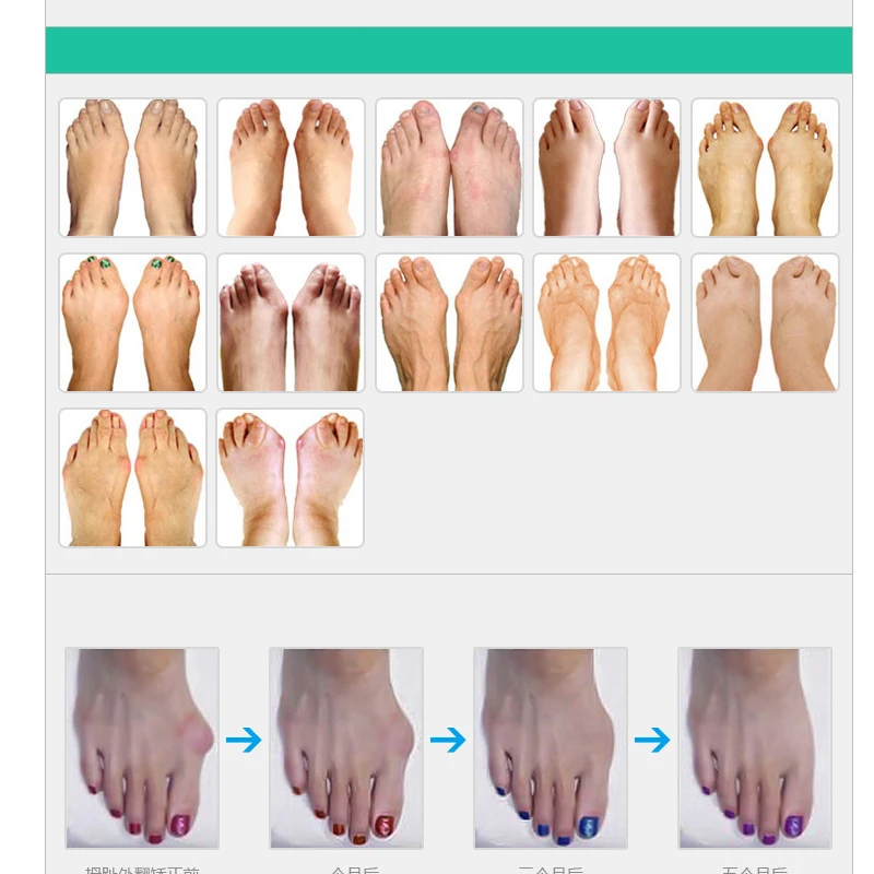 2Pcs/Pair Toe Seperator Foot Care Tool Silicone Gel Big Toe Bunion Thumb Pedicure Orthopedic Hallux Valgus Corrector