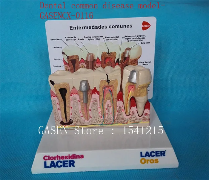 

Nursing oral dental model Medical model Nursing tooth model Oral tooth model Dental common disease model-GASENCX-0116