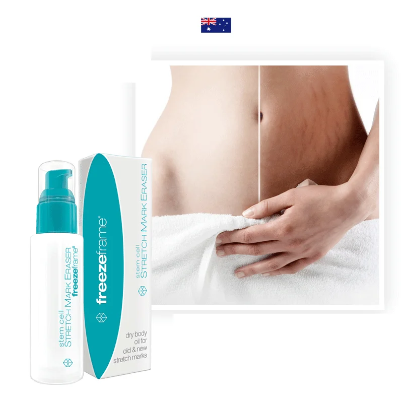 new stretch mark cream
