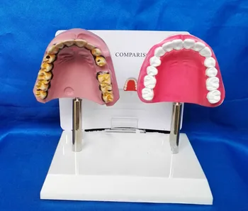

Nursing Tooth Model Medical Pathological Teeth Oral Care Model Tooth Teaching Model Smoking Oral Tooth Model Medical Supplies