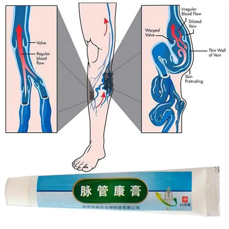 Китайская натуральная травяная медицина для лечения варикозного сосудистого воспаления массажный крем лечение Варикозного расширения вен мазь 20 г/кор